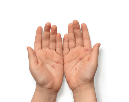 Children hands with chickenpox, rash and blisters. Hands with blisters isolated on white backgroundの写真素材