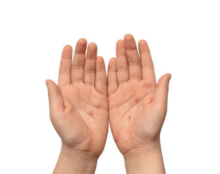 Children hands with chickenpox, rash and blisters. Hands with blisters isolated on white backgroundの写真素材