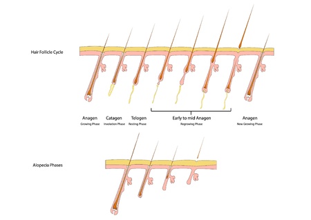 hair follicles and alopeciaのイラスト素材