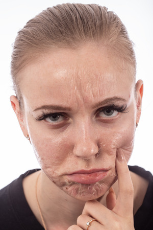 female face with burned skin after chemical peelingの写真素材