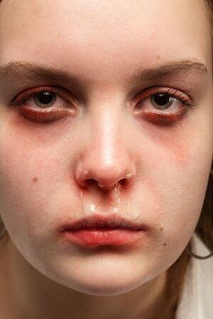 sad face of a cold girl with a flu with a runny nose and a temperature looks at the camera, closeup portraitの写真素材