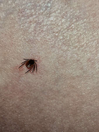 Tick with its head sticking in human skin, red blotches indicate an infection