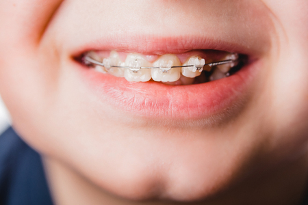 braces dental smile face teethの写真素材