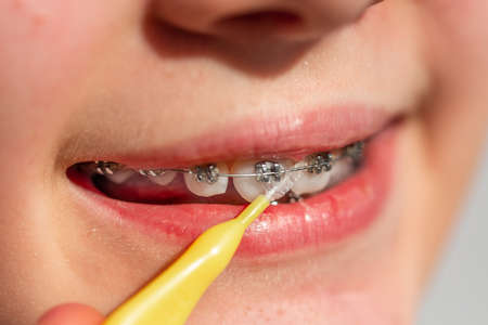 Close up of a teenage girl smiling in orthodontic brackets. Girl with braces on teeth. Orthodontic Treatment.の写真素材