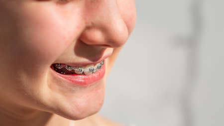 Close up of a teenage girl smiling in orthodontic brackets. Girl with braces on teeth. Orthodontic Treatment.の写真素材