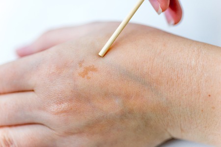 a birthmark or a mole on a woman skinの写真素材