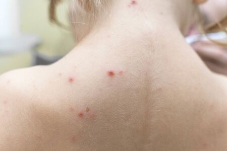 the baby's back is covered with a red rash of chickenpox. chickenpox infectious diseaseの写真素材