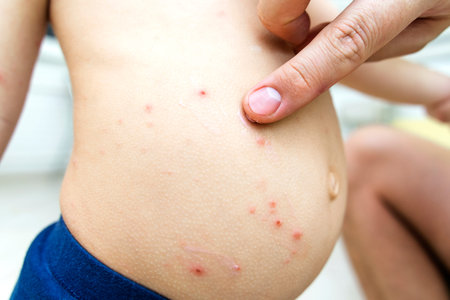 chickenpox treatment. papa’s hand lubricates with medicinal ointment inflammation from chickenpox...
