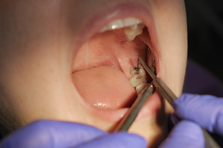 Dentist examines patients tooth with black cavity on it using dental tools and mirror. Tooth decay in opening mouth closeup.の写真素材