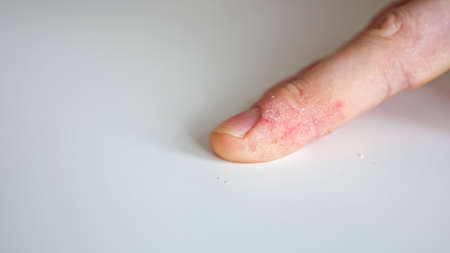 Fingers of a man with psoriasis and eczema close-up.の写真素材