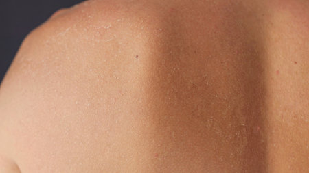 Sunburned skin on woman shoulder shows ocean beach rest under sun. Flaky skin adds unexpected mark to otherwise glowing skin. Effects of tropical sunの写真素材