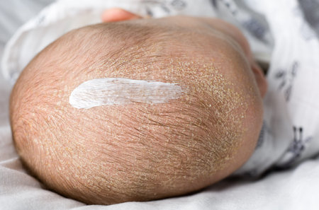 seborrheic dermatitis on baby's face. Sleeping newborn child with seborrhea on the forehead