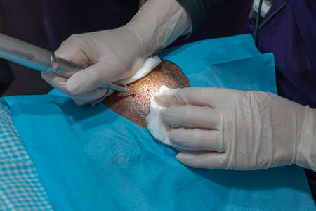 Closeup view of Hair Implantation Process