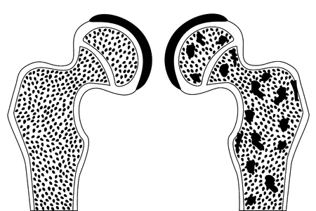 Hip bone healthy and with osteoporosis vector eps 10のイラスト素材