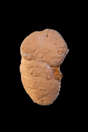 many abscesses of kidney isolated on blackの写真素材