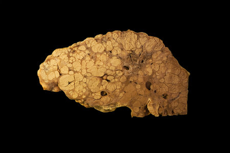 postnecrotic cirrhosis of liver isolated on blackの写真素材