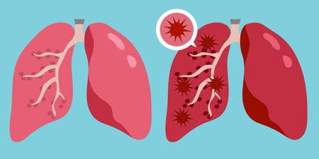 Sign Infographic with Cartoon has Cough, Fever, Sore Throat and Cold in Coronavirus or Covid-19 Outbreak. Healthy lungs and disease lungs. Vector Illustration.のイラスト素材