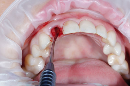 Dental surgeon performs conduction anesthesia with lidocaine using a carpool syringe female patients...
