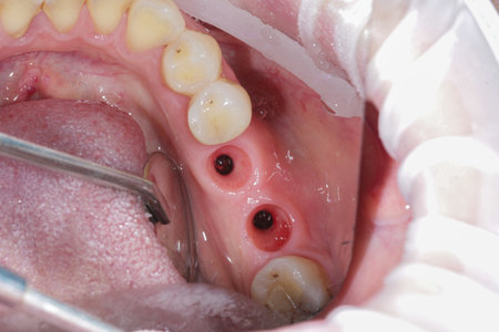 Screwed dental implants in the jaw. Concept of modern procedure in dentistry, dental implants multi unit abutment, real human mouth, upper row. Dental decay, cavityの写真素材