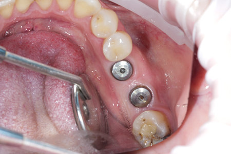 Screwed dental implants in the jaw. Concept of modern procedure in dentistry, dental implants multi...