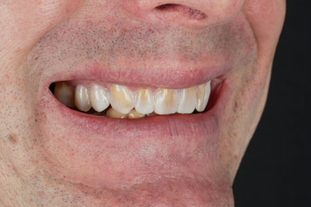 Fitting the mock-up of future teeth. Man is smiling and demonstrating the teeth in dentist office.の写真素材