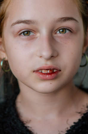 little girl with a broken lip. Girl with a broken lip. Teen hurt her lip