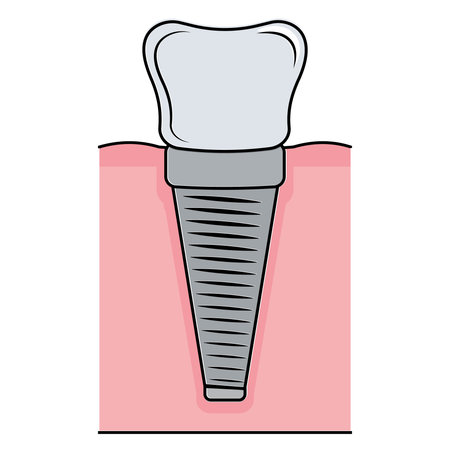 Dental implant. Screw prosthesis, Illustration of dental implantation,orthodontic dental implantationのイラスト素材