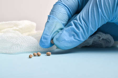 Selective focus. The surgeon holds the removed stones after the operation laparoscopic.の写真素材