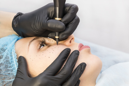 Permanent microblasting tattooing freckles to a woman in a beauty salon