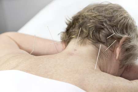 Elderly woman undergoing acupuncture procedure in a fat spa.の写真素材
