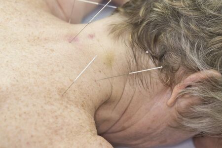 Elderly woman undergoing acupuncture procedure in a spa.の写真素材