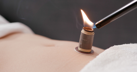 Chinese medicine moxibustion therapyの写真素材