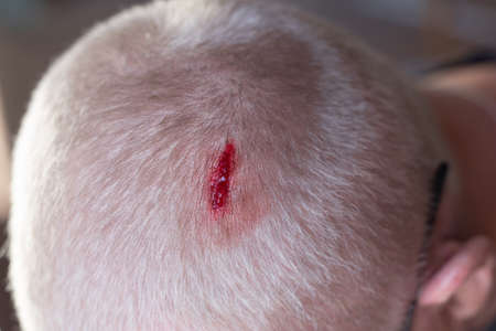 Injury to the scalp. Blood leaks from a chopped wound on the head of a blond man due to falling metal reinforcement. Non-observance of safety .precautions.の写真素材