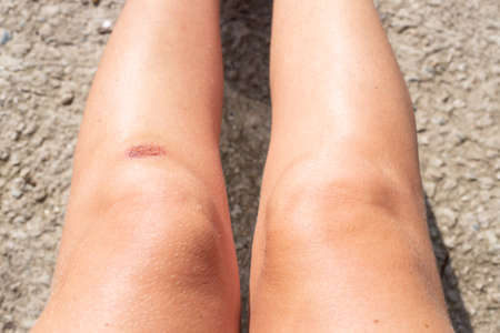 Beautiful female legs with a broken knee. First aid for falls, injury.の写真素材