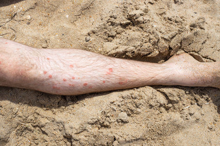 many red, scaly ulcers on a man's leg. Immune disease psoriasis and UV treatment on a summer day on the sea sand.の写真素材