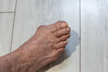 An old woman's leg. A foot with unkempt long nails and a sore big toe joint.