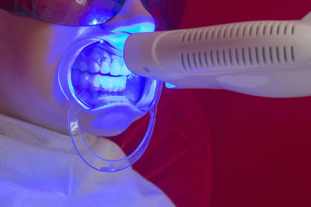 teeth whitening procedure ultraviolet lamp whiten teeth girl mouth extenderの写真素材