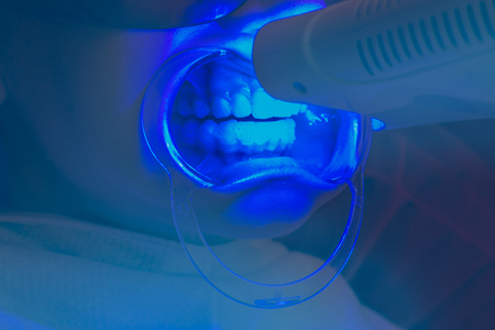 teeth whitening procedure ultraviolet lamp whiten teeth girl mouth extenderの写真素材