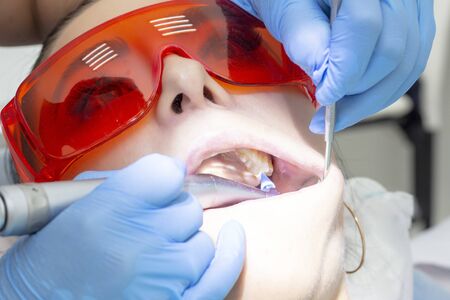 girl patient at the reception at the dentist. treatment of carious tooth. the girl lies on the dental chair with his mouth open. A dentist and his assistant are treating a toothの写真素材