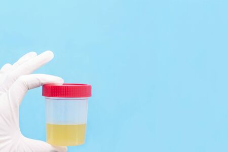 medical analysis of urine. The doctor holds in his hand a urine test in a jar with a red lid....