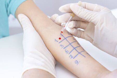 Allergen test on hand. child undergoing procedure of allergen skin test in clinic.の写真素材