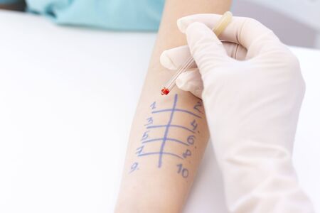 Allergen test on hand. child undergoing procedure of allergen skin test in clinic.の写真素材