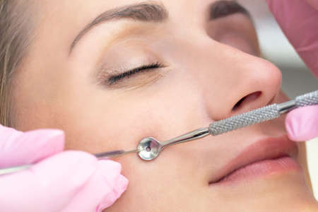 Procedure for cleaning the skin of the face with a steel appliance with a spoon from blackheads and acne.の写真素材