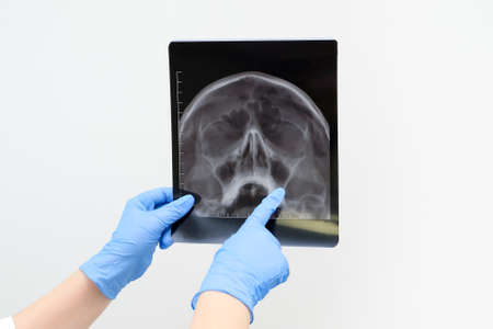 X-ray of the skull in the hand of a doctor. With copy space. Diagnosis of sinusitisの写真素材