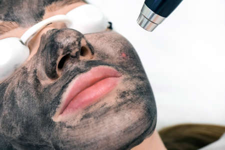 Carbon peeling of the face of a young beautiful woman. Peeling skin renewal. laser point on the face.の写真素材