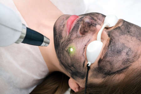 Carbon peeling of the face of a young beautiful woman. Peeling skin renewal. laser point on the face.の写真素材