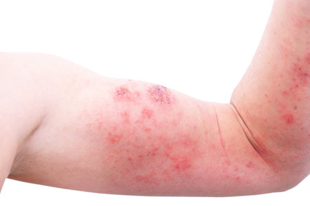 Atopic dermatitis (AD), also known as atopic eczema, is a type of inflammation of the skin (dermatitis).の写真素材