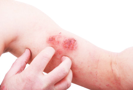 Atopic dermatitis (AD), also known as atopic eczema, is a type of inflammation of the skin...