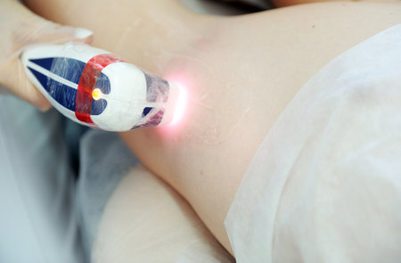 Man on laser hair removal procedure in a beauty salon. Hair removal conceptの写真素材