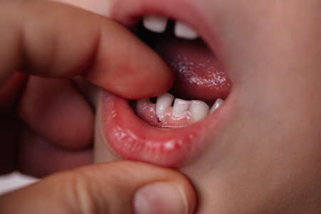 close-up the roots of a falling baby tooth stick out from the gum, the process of changing temporary teethの写真素材